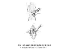 Osteomielita acuta