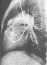 Stenoza pulmonara congenitala
