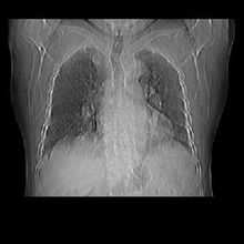 Boli de inima pulmonar acut
