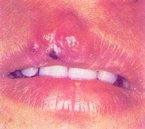 Herpes oral